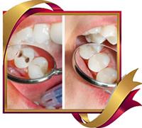 Restoratif Diş Tedavi İşlemleri